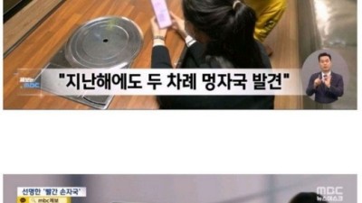 8살 장애아 등에 난 엄청난 손자국